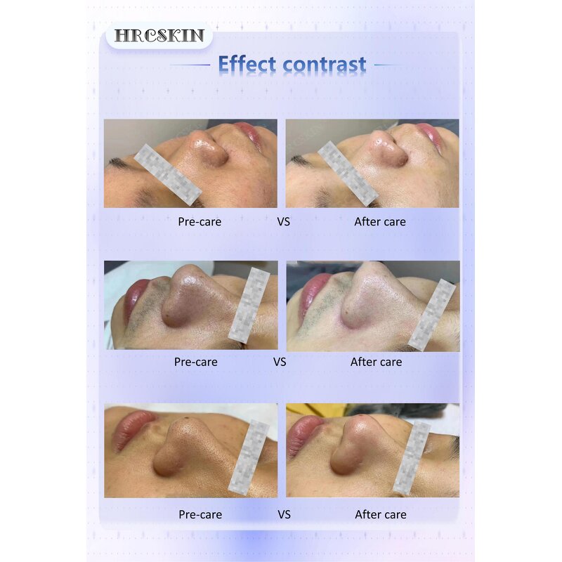 Hydro Facial Machine Manufacturer - Hydro Aqua Hydra Dermabrasion Skin Rejuvenation