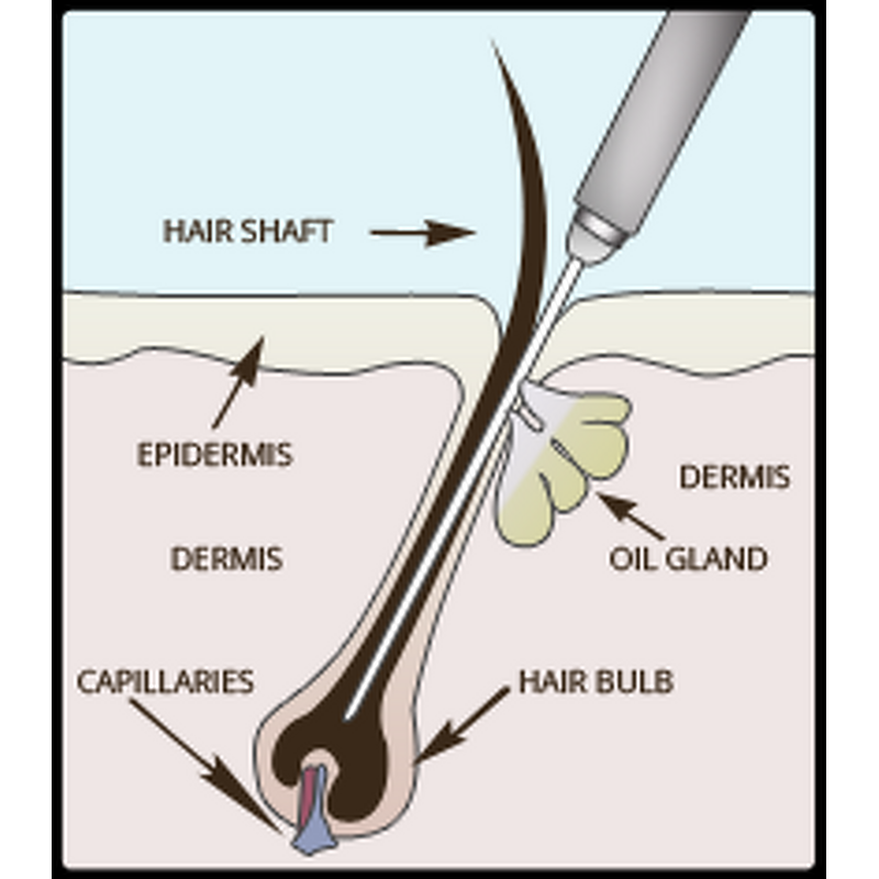 Electrolysis Hair Removal Machine Manufacturer - 13.26MHZ Non Invasive Electrolysis System