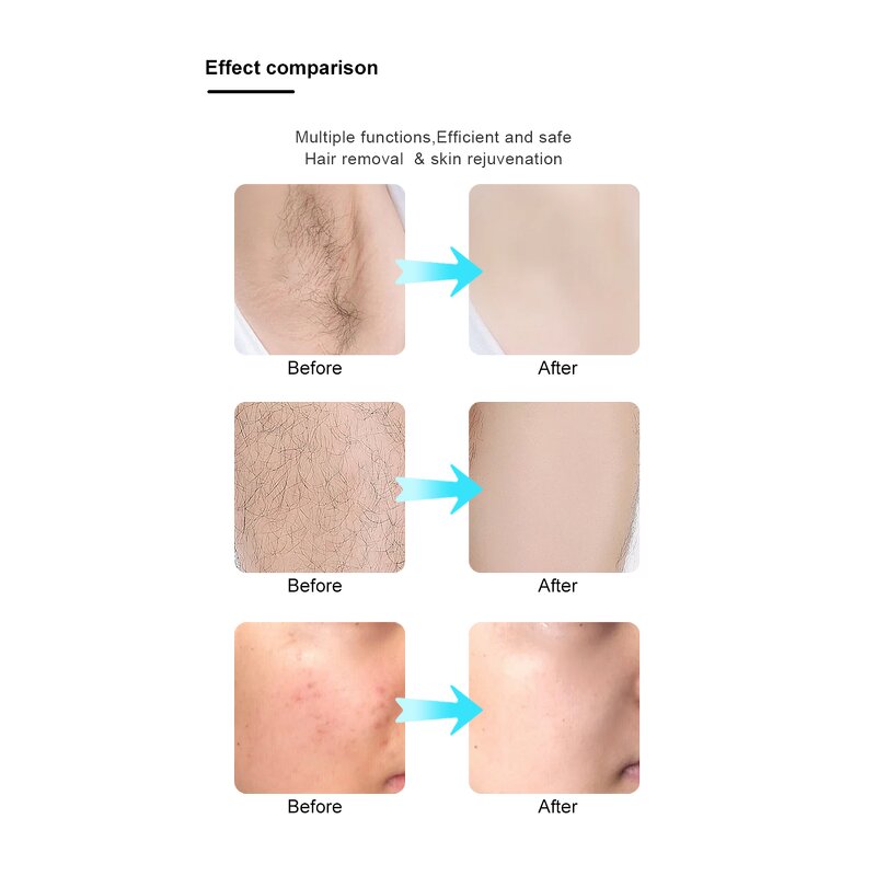 Tattoo Removal Machine Manufacturer - Pico Laser Eyebrows Removal Nd Yag Carbon Peeling Beauty Equipment