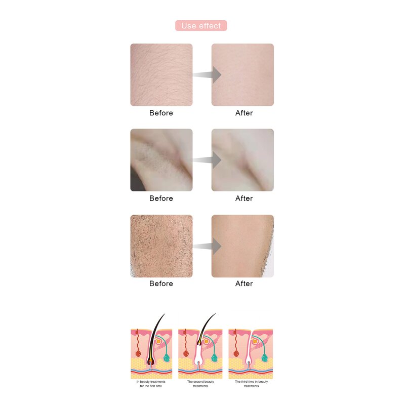 Hair Removal Machine Manufacturer - Portable OPT Painless for Skin Care IPL