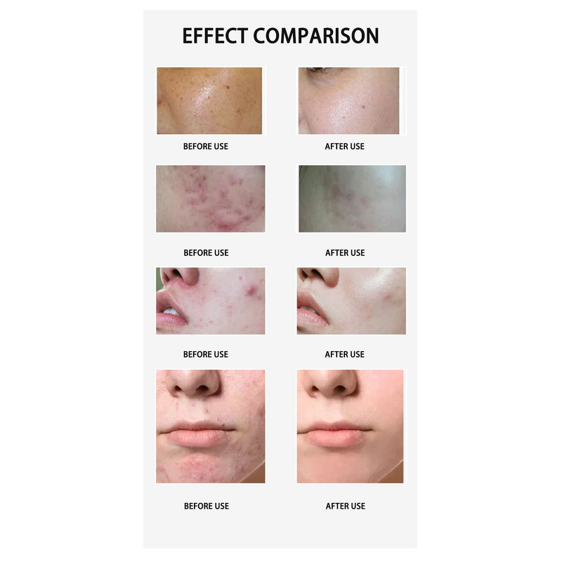 Butt Lift Enhancement Machine Manufacturer - Hot Sale Vacuum Suction Cup Breast Enlargement Device