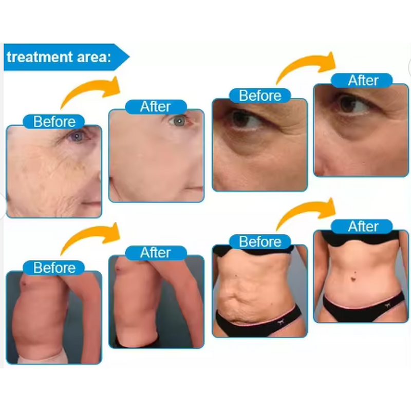 Micro Needle RF Hifu Device Manufacturer - 7d Hifu Face Body Care Anti-aging Beauty Device