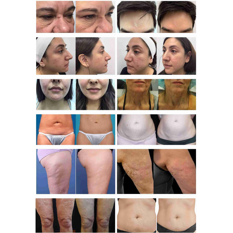 Thesera Pen Injector Manufacturer - Anti-Aging Facial Beauty Injector Pen