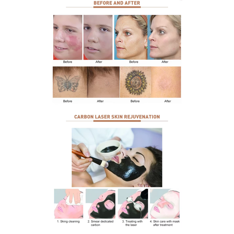 Picosecond Laser Machine Manufacturer - 532nm 755nm 1064nm 1320nm Tattoo Spots Freckle Removal Device