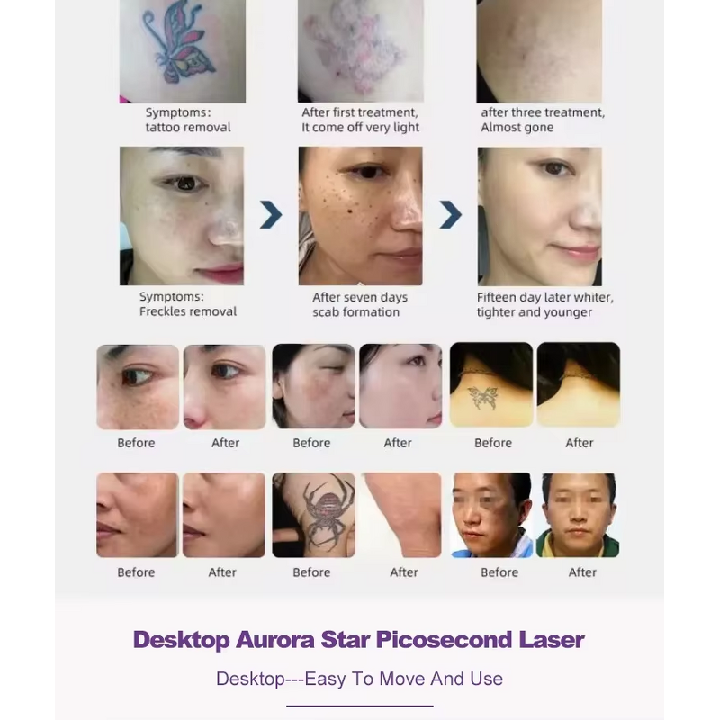 Multi-function Laser Machine Manufacturer - 10/12 Bar IPL 808nm Diode Picosecond RF Hair Tattoo Removal