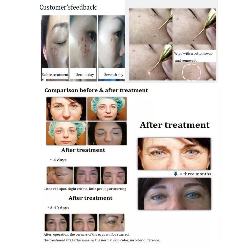 3 Handles Plasma Device - Facial Salon Wrinkle Removal Face Lifting Acne Removal Beauty Equipment