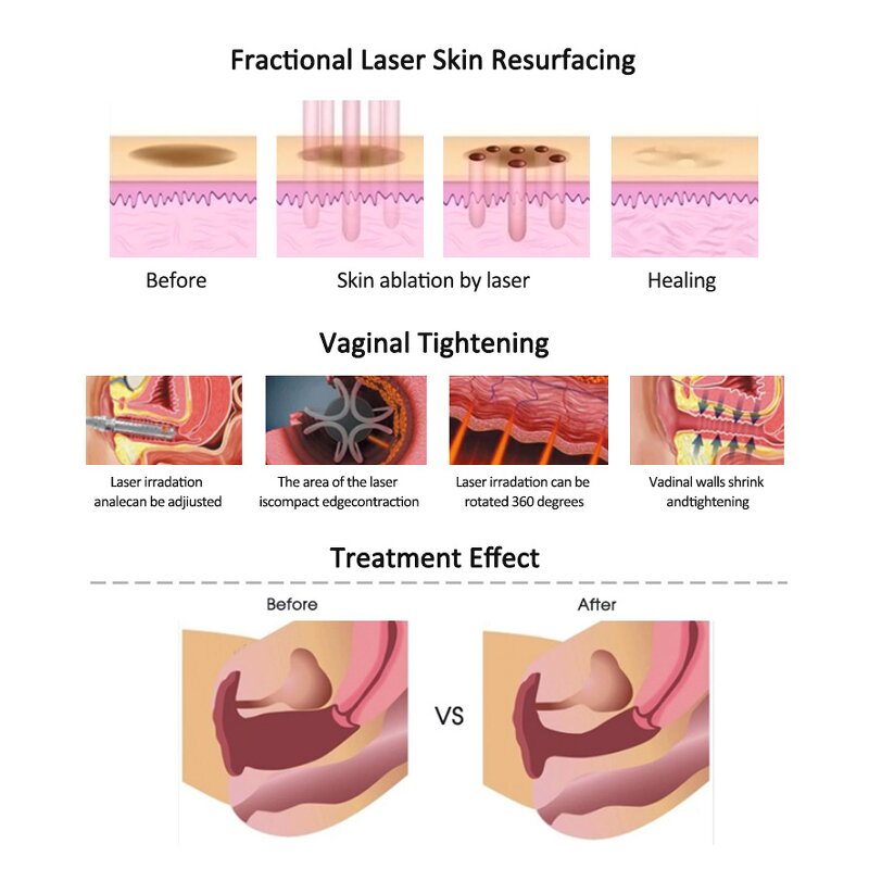 CO2 Fractional Laser Machine Manufacturer - 2025 Medical Home Use Aesthetic Acne Scar Treatment Beauty Equipment