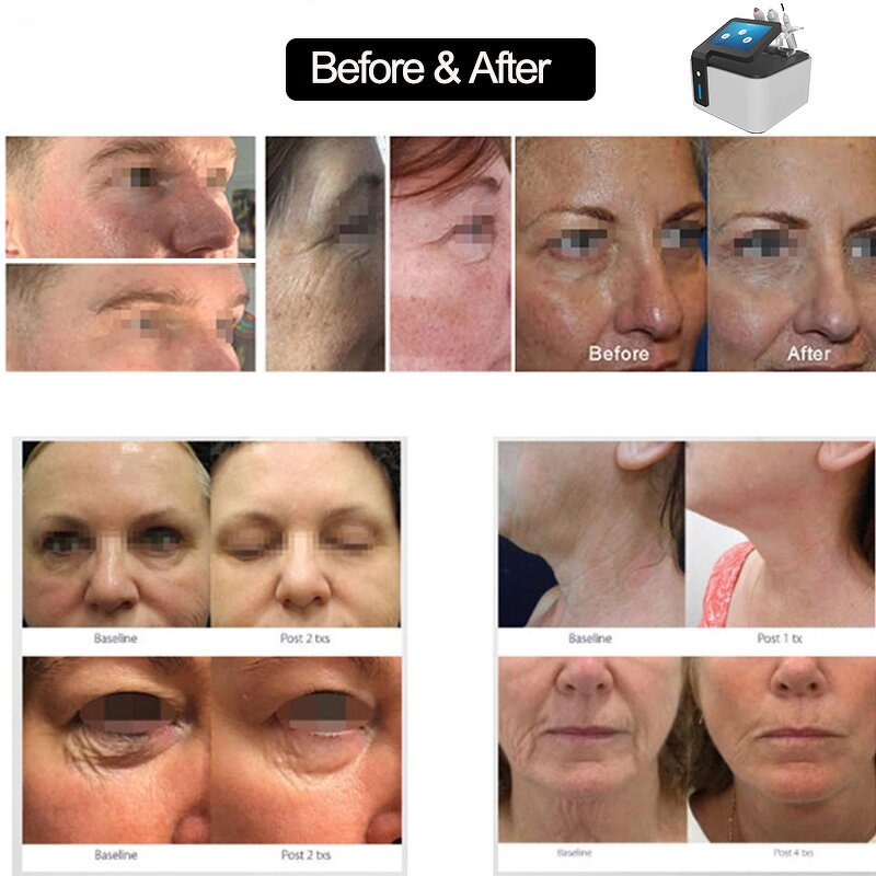 3 Handles Plasma Device - Facial Salon Wrinkle Removal Face Lifting Acne Removal Beauty Equipment