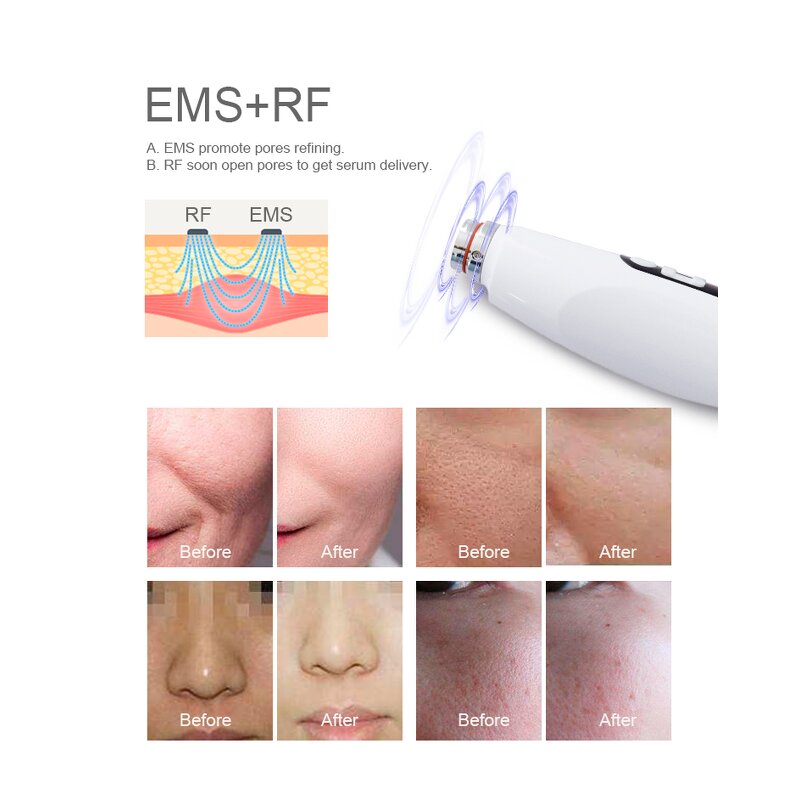 EMS Mesotherapy Machine - Non-Invasive Needle-Free Water Light Microcrystalline Chip RF Beauty Personal Care