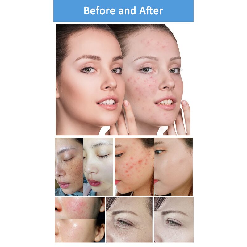 Elight IPL Machine - Hair Removal Skin Rejuvenation Whitening Acne Spot Removal Dual Handles Salon Device