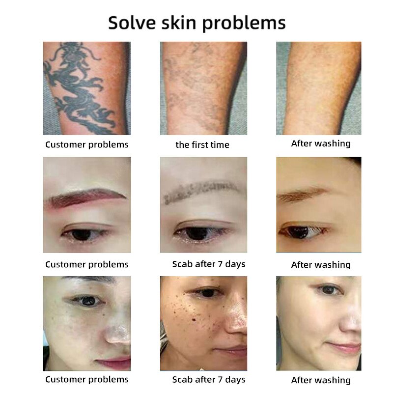 Picosecond Laser Machine Manufacturer - 532/1064nm All Color Pigment Freckle Removal Clinic Portable Beauty Equipment