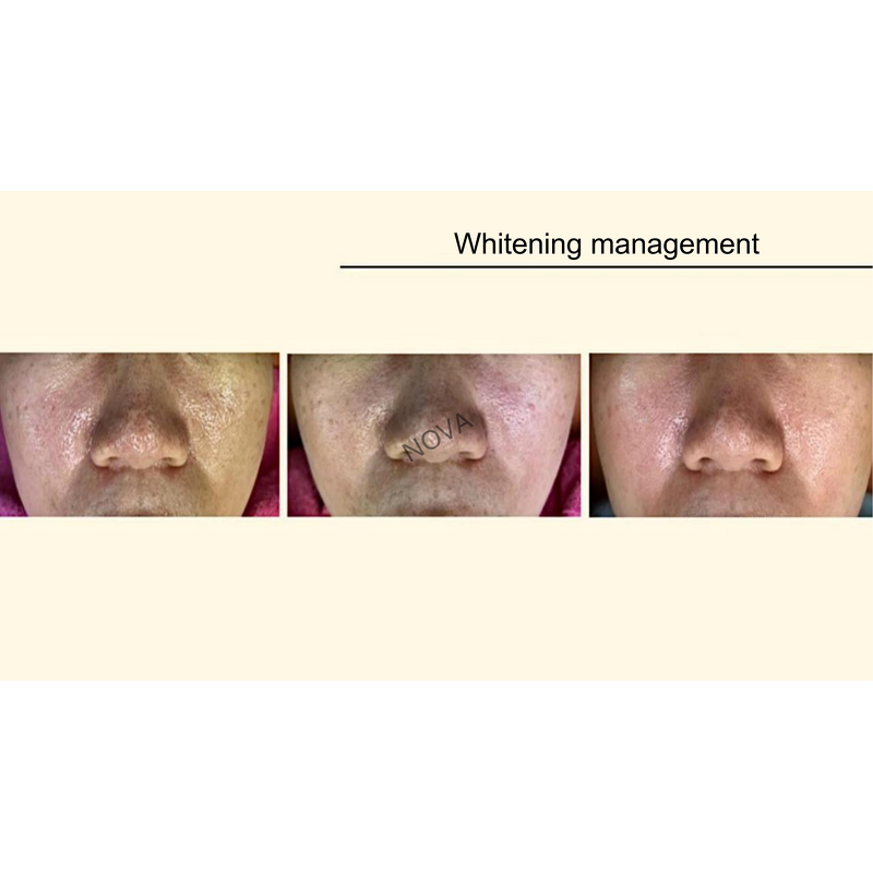 Plasma Therapy Machine - Wound Reduction 40% Bacteria Acne Allergies Dermatitis Eczema Wound Recovery Device