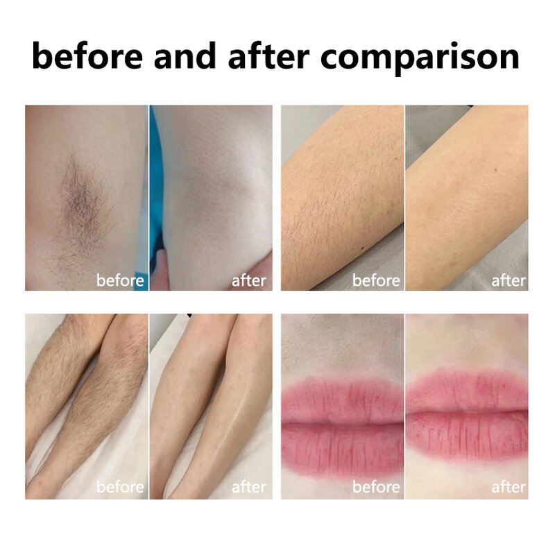 Portable Diode Laser Machine Manufacturer - 2025 NEW 755 808 1064 808nm Personal Use Hair Removal Equipment