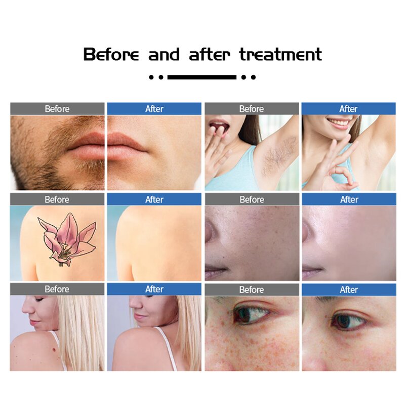 NOVA NV-TMY5 Laser Machine Manufacturer - Professional 2 in 1 755/808/1064nm Diode Laser Commercial Hair Removal Equipment