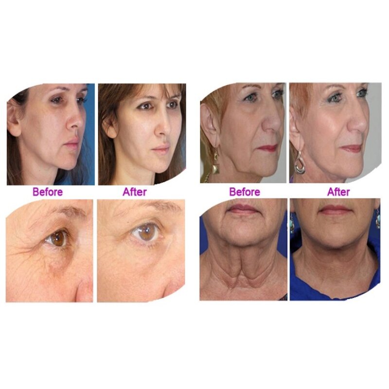 Near NB-06-1 RF Machine Manufacturer - 2 in 1 Radar Line Carving Face Wrinkle Removal Lifting 2 Year Warranty