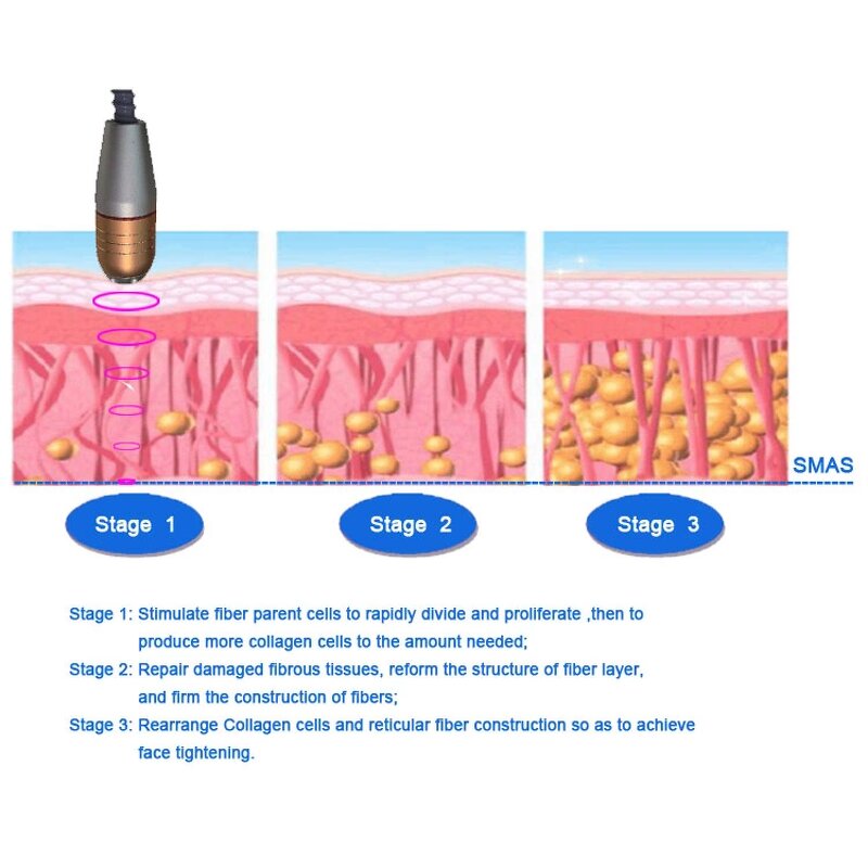 Near NB-06-1 RF Machine Manufacturer - 2 in 1 Radar Line Carving Face Wrinkle Removal Lifting 2 Year Warranty