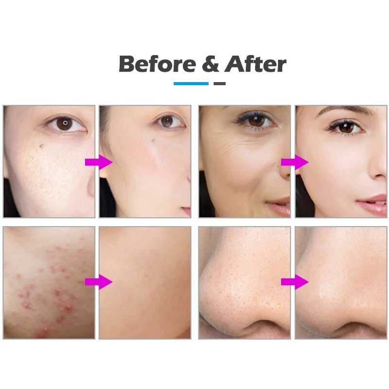 Near NB-03-2 Beauty Machine Manufacturer - 7 in 1 Aqua Dermabrasion Jet Vacuum Peeling LED Facial Mask Bio Lifting