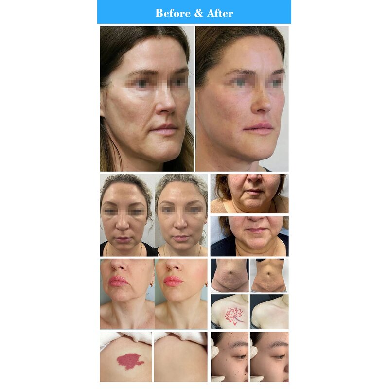 CO2 Fractional Laser Device Manufacturer - 2024 RF Tube 2000w Professional Skin Beauty Instrument