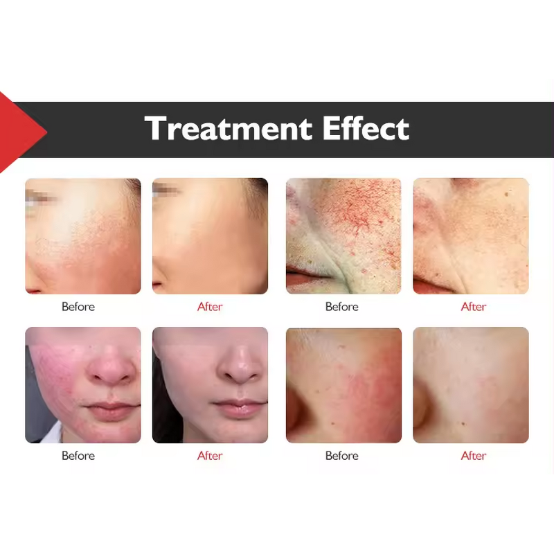 980nm Diode Laser Manufacturer - Nail Fungus Vascular Toenail Red Blood Filaments Removal Tool