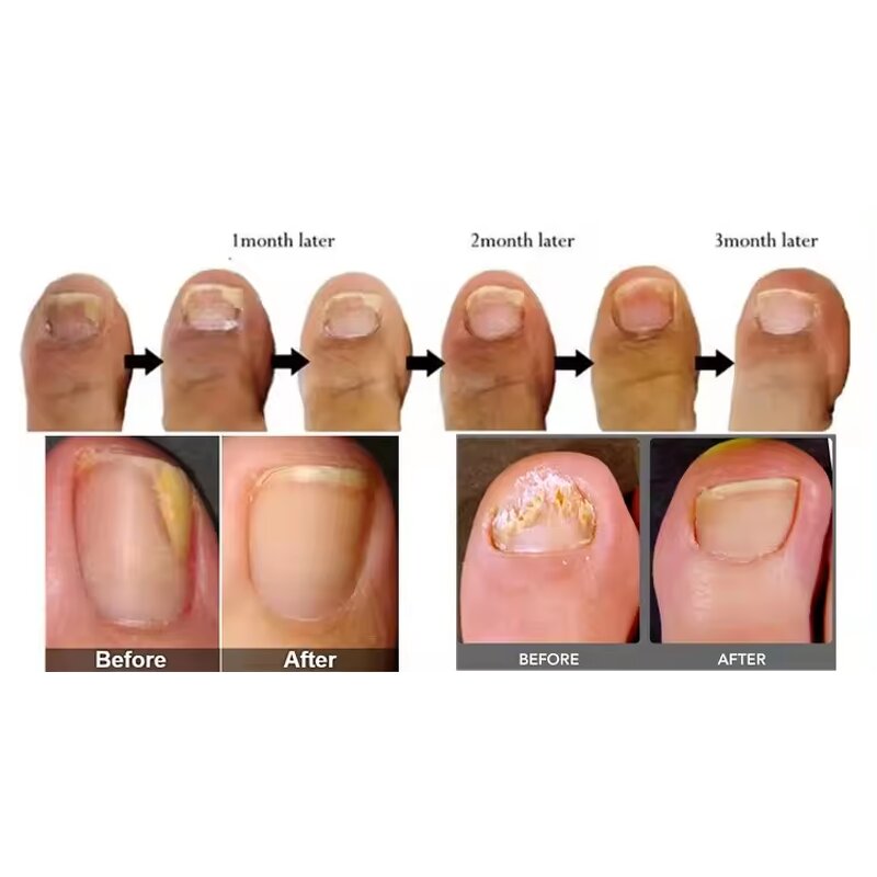 980nm Diode Laser Manufacturer - Nail Fungus Vascular Toenail Red Blood Filaments Removal Tool