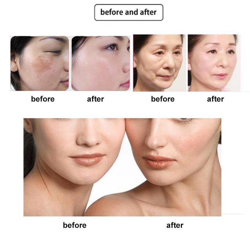 40.68mhz ThermoLift Device Manufacturer - Top Selling Face Lifting Wrinkle Removal Monopolar Rf Beauty Tool