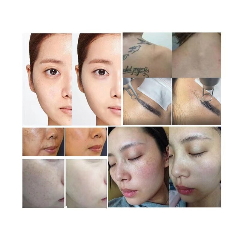 Pico Laser Tattoo Removal Machine Manufacturer - Best Selling 532/755/1064nm Qswitch Nd Yag Eyebrow Laser Tool