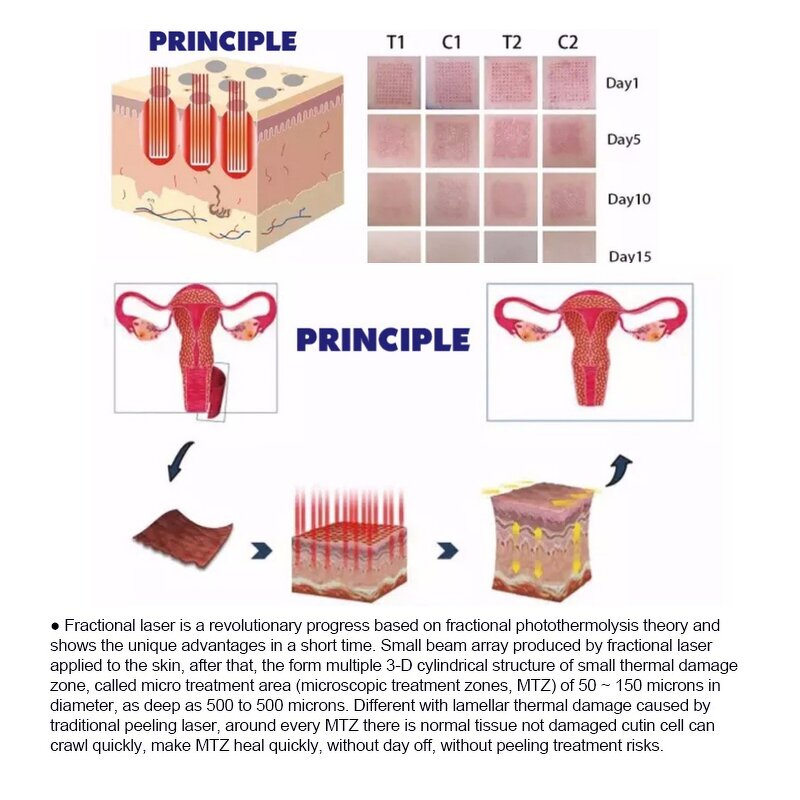 Co2 Fractional Laser Machine Manufacturer - Best Metal Tube 10600nm Stretch Mark Removal Skin Resurfacing 60w Tool