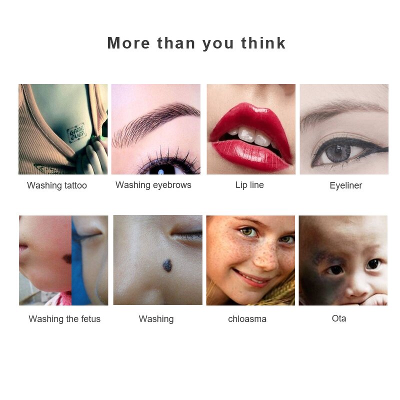 Q Switched Nd Yag Laser Machine Manufacturer - Portable 532/755/1320/1064nm Carbon Peel Eyebrow Tattoo Removal Tool