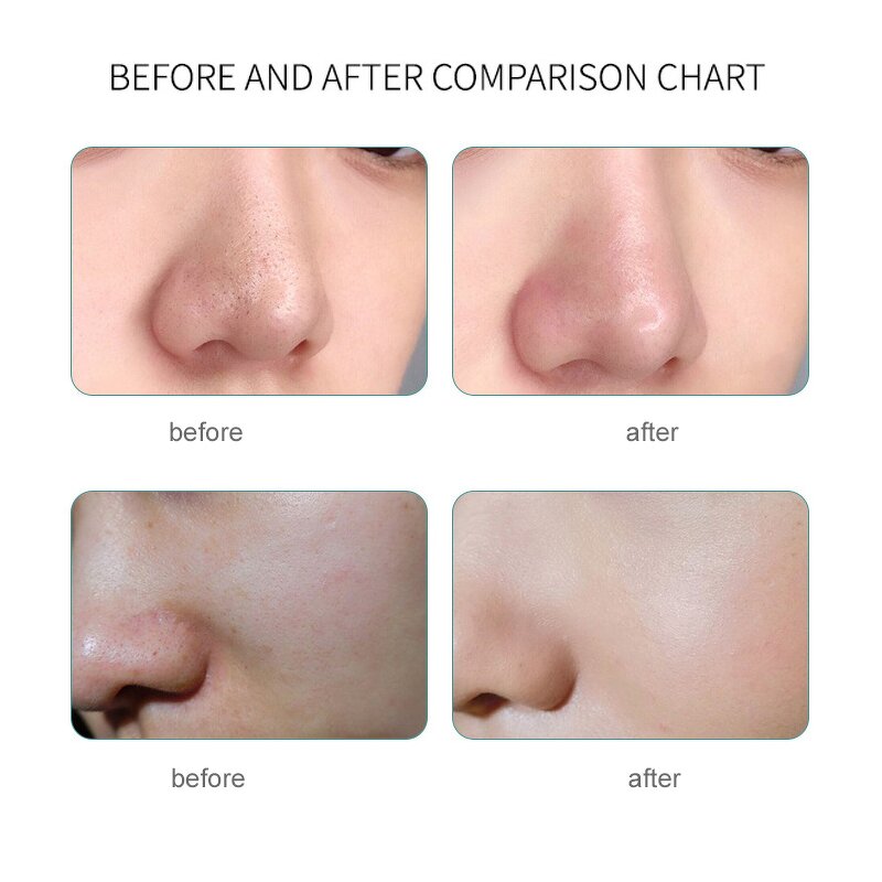 7 in 1 Micro Bubble Hydrodermabrasion Manufacturer - Best Selling Aqua Peel Hydra Whitening Salon Spa Beauty Tool