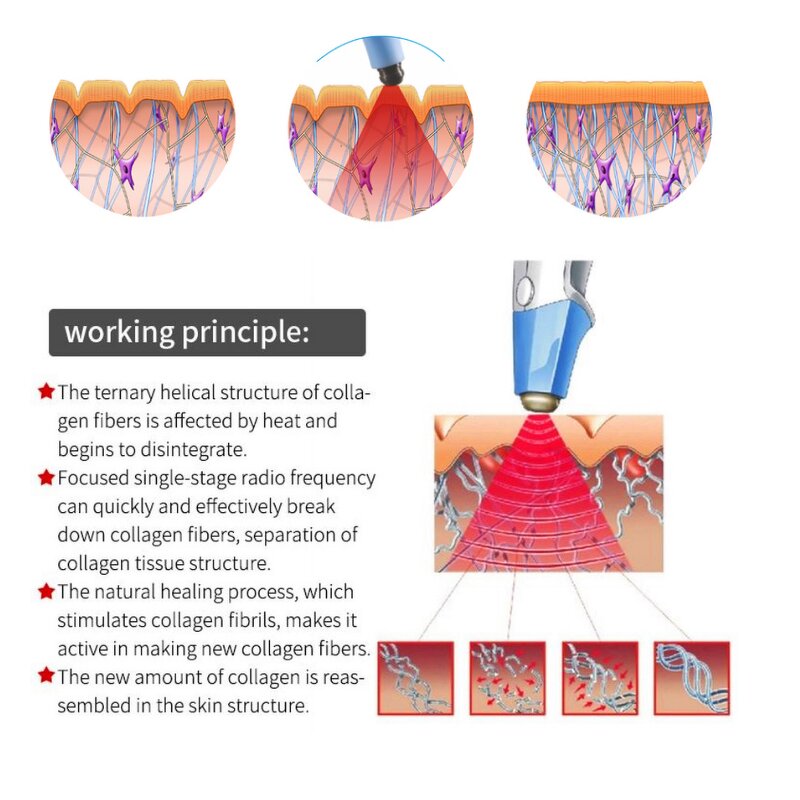 Excilift Ultra360 RF Machine Manufacturer - Factory Price Eye Bag Removal Monopolar Rf Skin Tightening Tool