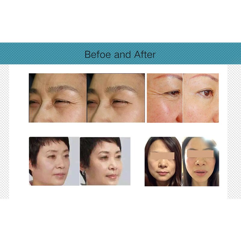 40.68hz Thermo Firming RF Machine Manufacturer - Face Lifting Skin Tighten Body Slimming Dual Handle 350w Tool