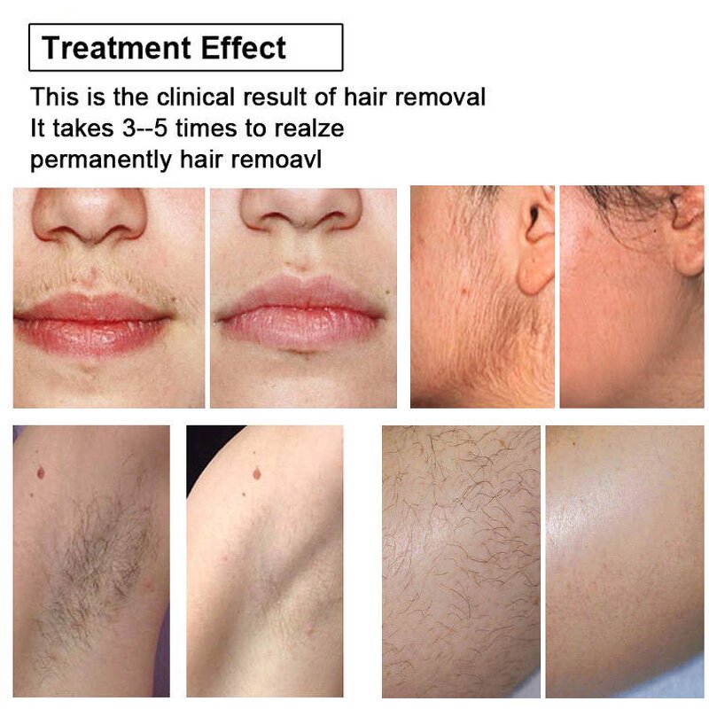 3 Wavelength Nd Yag Laser Manufacturer - 2025 810/808/1064nm 800w 1800w Diode Hair Removal Machine