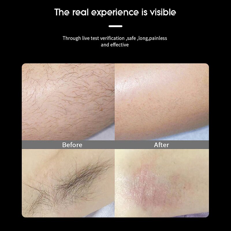 Ice Cool IPL Laser Machine Manufacturer - 2000w Hair Removal Whitening Skin Rejuvenation Battery Commercial Tool