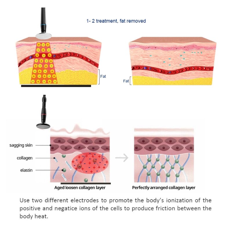 448khz Monopolar RF Machine Manufacturer - Weight Loss Skin Tightening Face Lift Standing Head IT ZA CN Tool