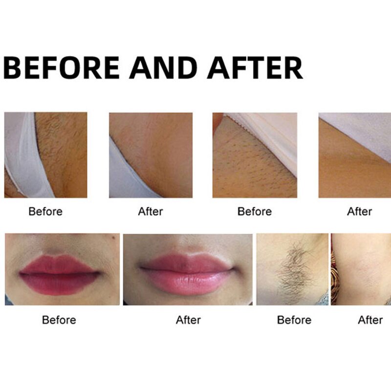 Diode Laser Machine Manufacturer - 808nm 1000W Salon Grade Painless Hair Removal