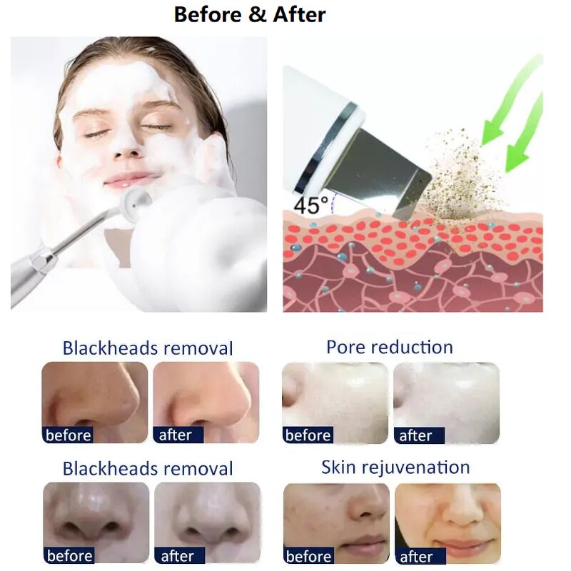 Hydra Beauty Facial Machine Manufacturer - 14-in-1 Micro Dermabrasion Standalone for Lip US EU