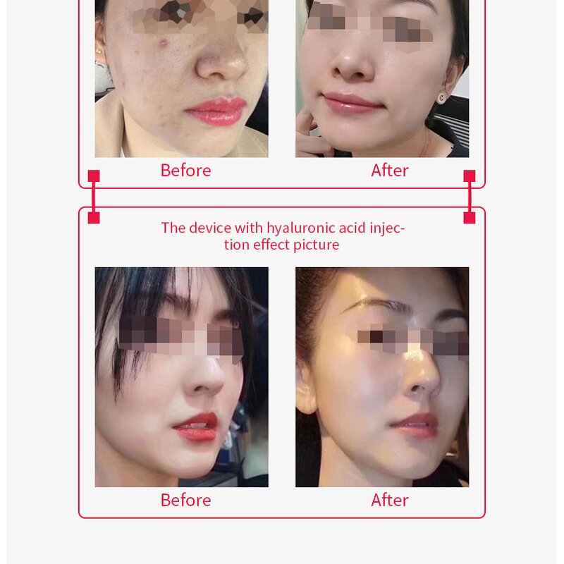 BB Face Beauty Device Manufacturer - 2024 Portable Hot Selling Mesotherapy for Skin Rejuvenation