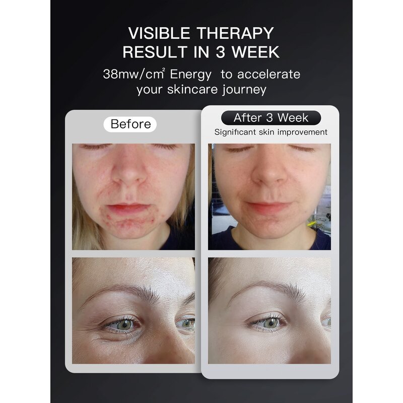 LED Light Therapy Mask Manufacturer - Smart Travel Skin Care Silicone