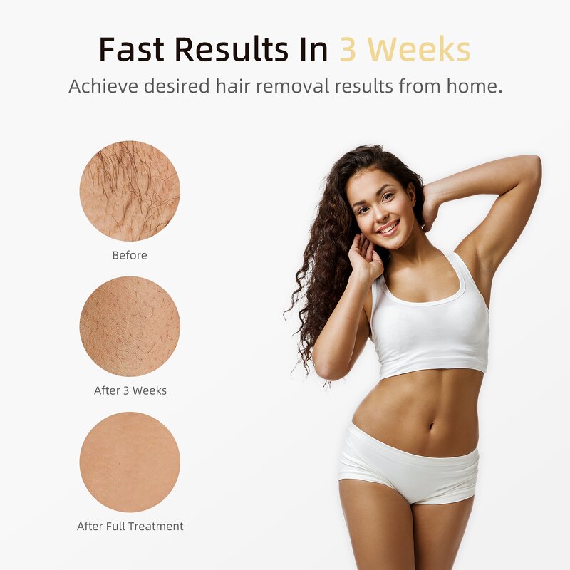 IPL Hair Removal Device Manufacturer - Portable with Ice Cooling for Home