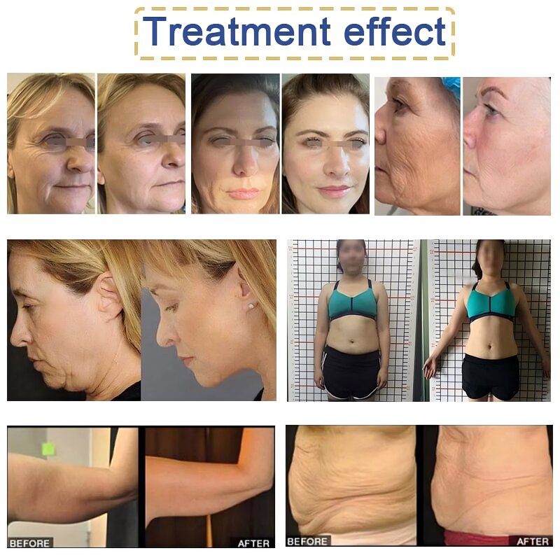 9D HI Face Lifting Machine - Top Beauty 12 Lines Wrinkle Reduction Device