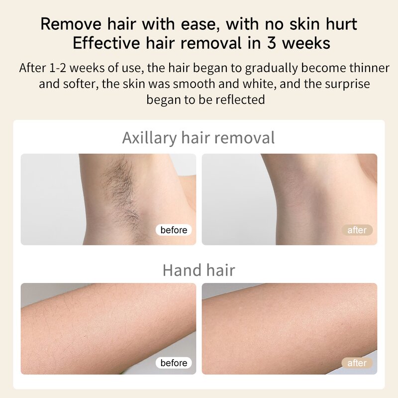 IPL Hair Removal Device Manufacturer - 10-15J Energy Adjustable for Women & Men