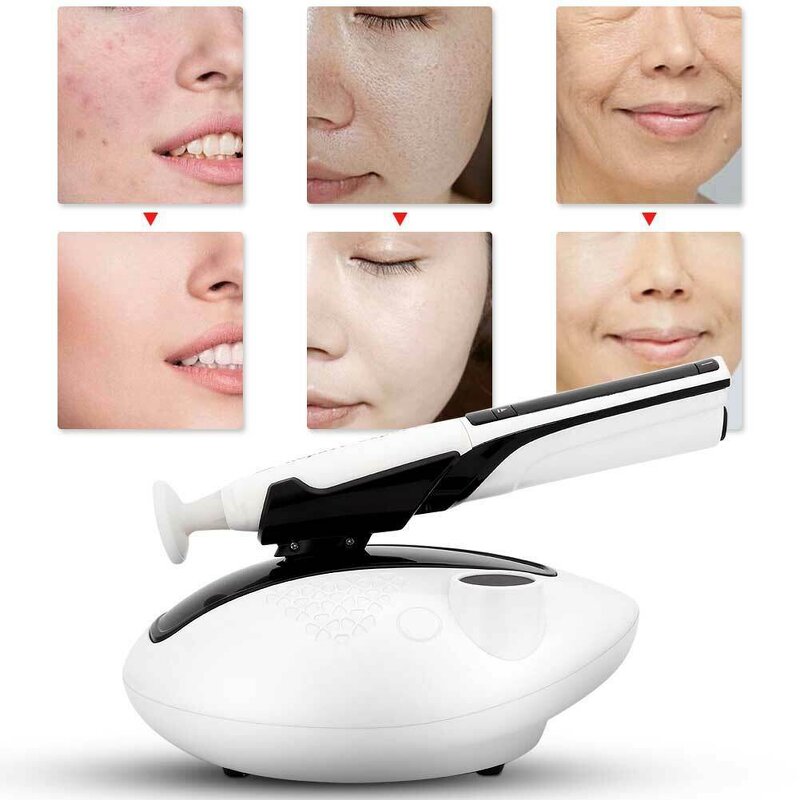 Stainless Steel Plasma Ozone Pen - Portable Cold Latest Skin Lifting 15g Tips