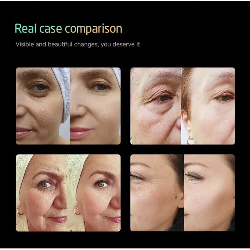 25D Hiifu Device - Newest 360 Degree 3 In 1 Skin Tightening Wrinkle Removal Care