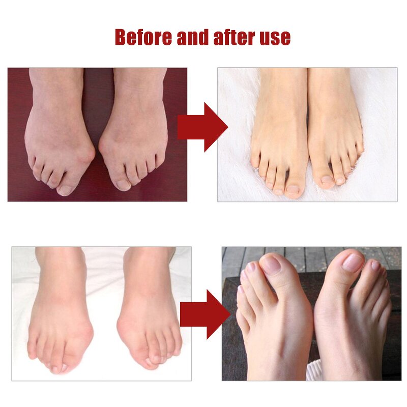 Hallux Valgus Correction Manufacturer - Super Soft Silicone Protector Toe Separator
