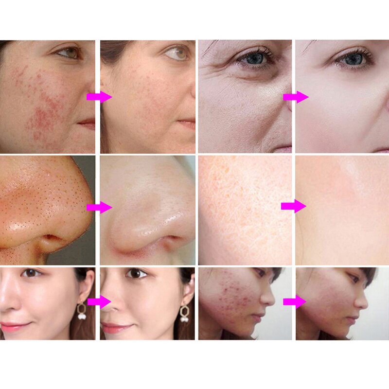 14 in 1 Hydra Machine - Vertical Professional RF Skin Whitening Acne Removal