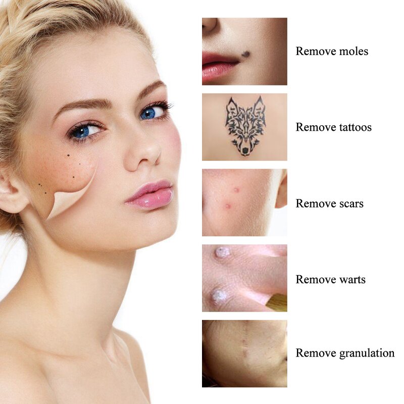 Laser Mole Removal Pen - Point Mole Pen Home Use Beauty Removal Machine