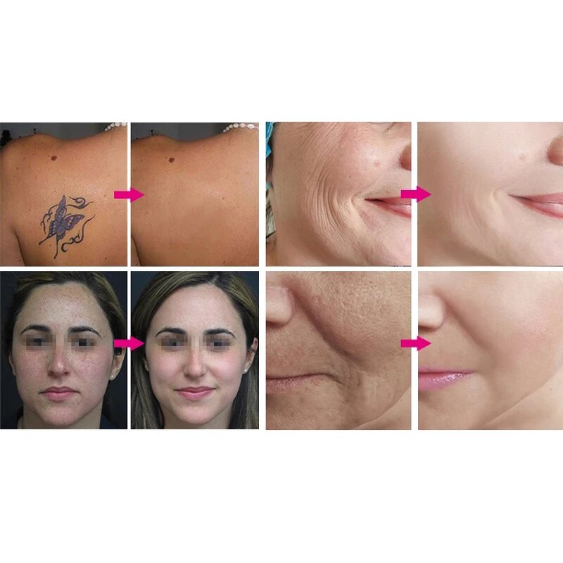 Picosecond Laser Machine - Carbon Peeling Tattoo Pigment Removal with 3 Heads