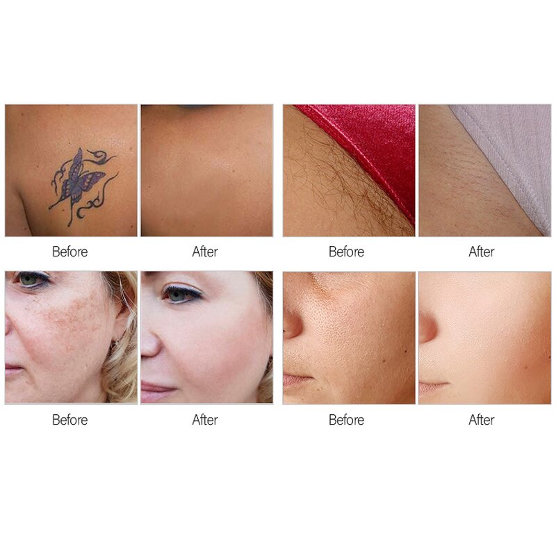 2 in 1 Pico Laser Machine - 2024 New Portable 808nm 1064nm 755nm Hair Removal