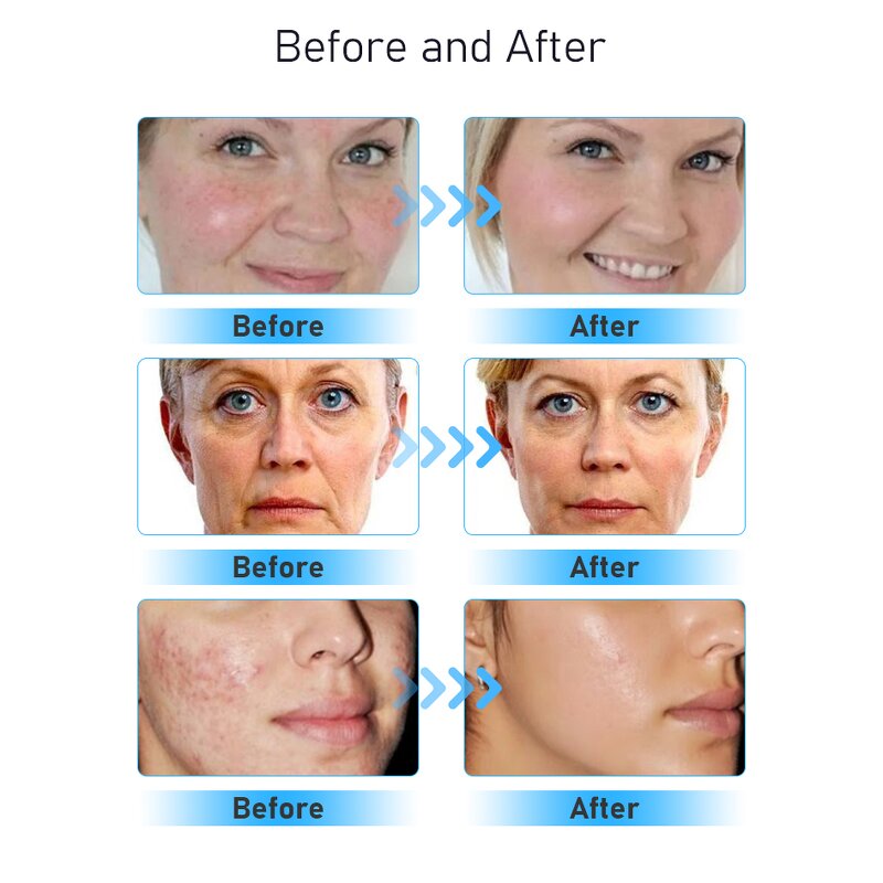 6 in 1 Micro Dermabrasion - Hot Sell Hydrodermabrasion RF Aqua Peel Skin Scrubber