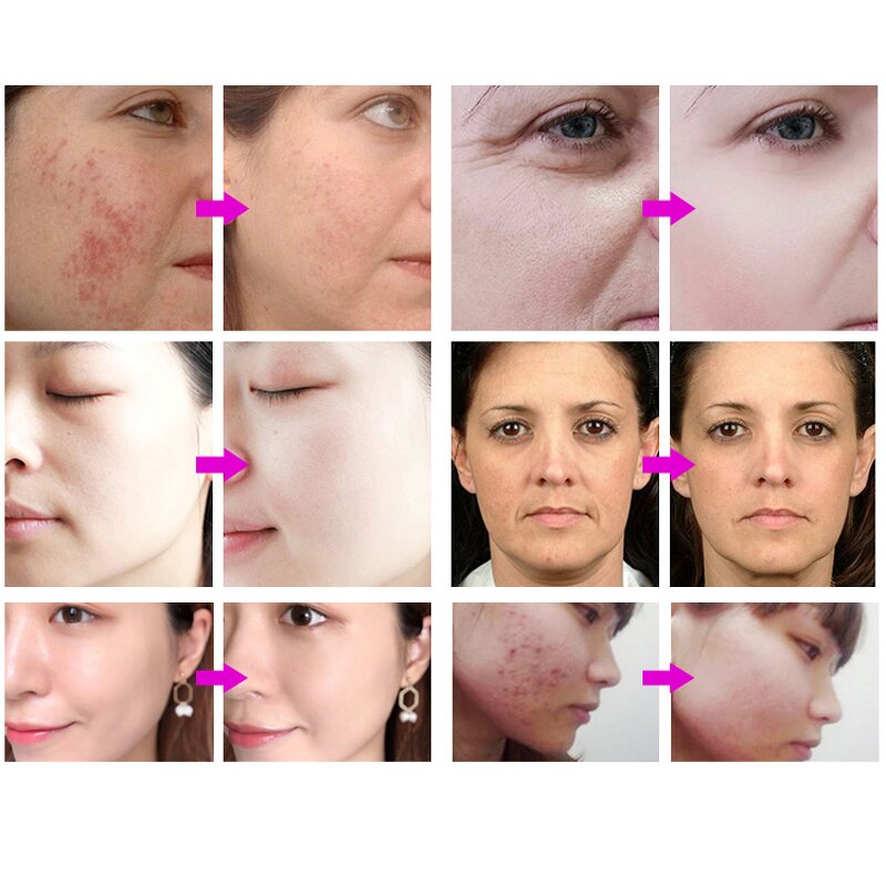 RF Facial Machine - USB Cable Acne Tightening Thermal Face Neck Eye Lifting